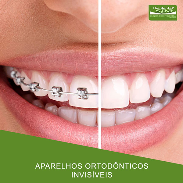 aparelhos-ortodonticos-invisiveis-