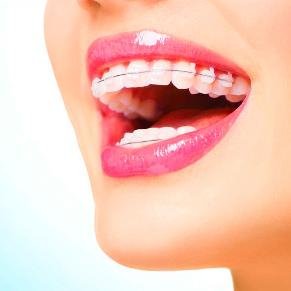 tratamento-ortodontia-aparelhos-autoligados2